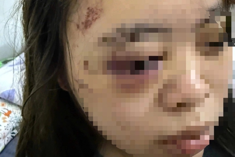 Vết thương trên người A.T. Ảnh: Dân Trí
