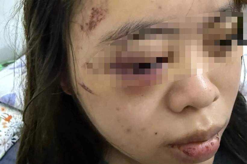 Sau khi bị đánh hội đồng, nữ sinh L. vẫn hoảng loạn. Ảnh: Dân Trí