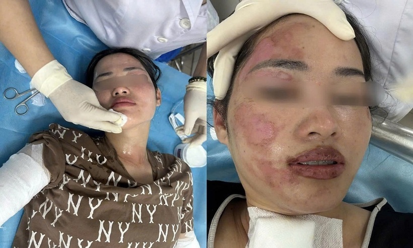 Cô gái bị tổn thương nặng ở vùng mặt, cổ và cánh tay.