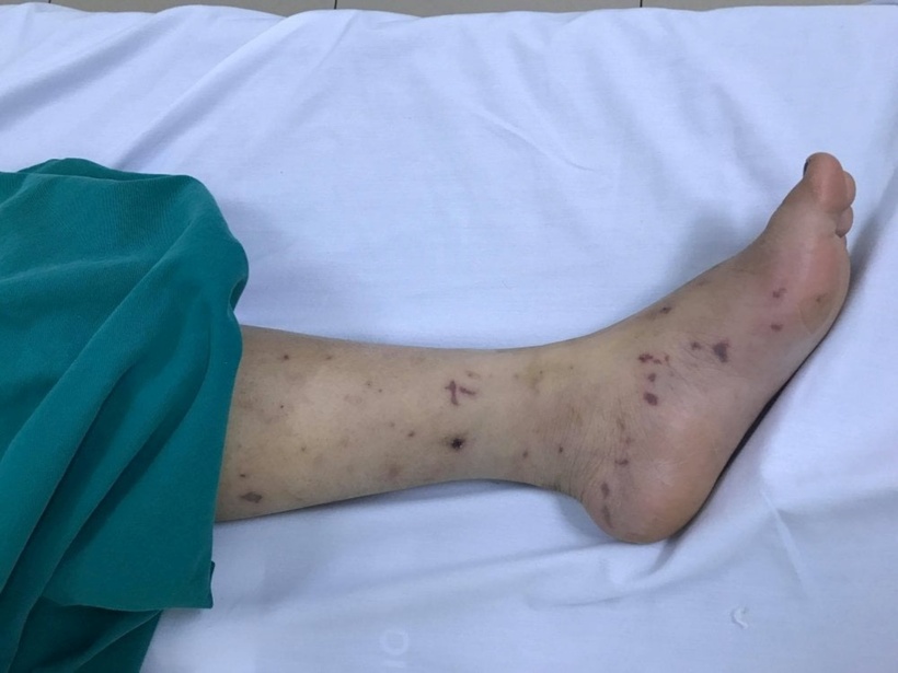 Mắc bệnh não mô cầu chủ yếu là người trẻ tuổi, những người chưa có miễn dịch, tiêm phòng. Ảnh minh họa.