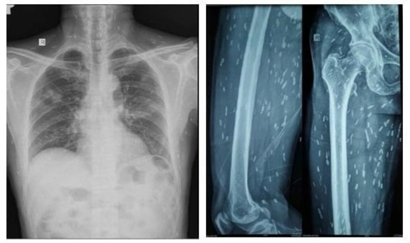 Nang sán chi chít cơ thể người đàn ông. Ảnh: BVCC.