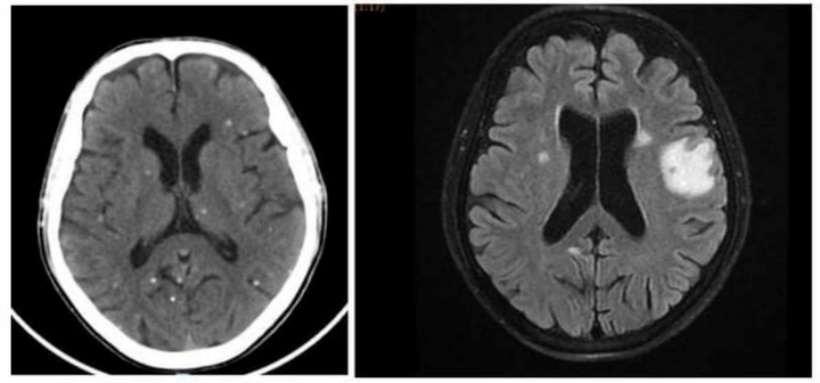 Vô số nang sán dải còn sống hoặc đã bị hóa vôi “ẩn nấp” trong não. Ảnh: BVCC.