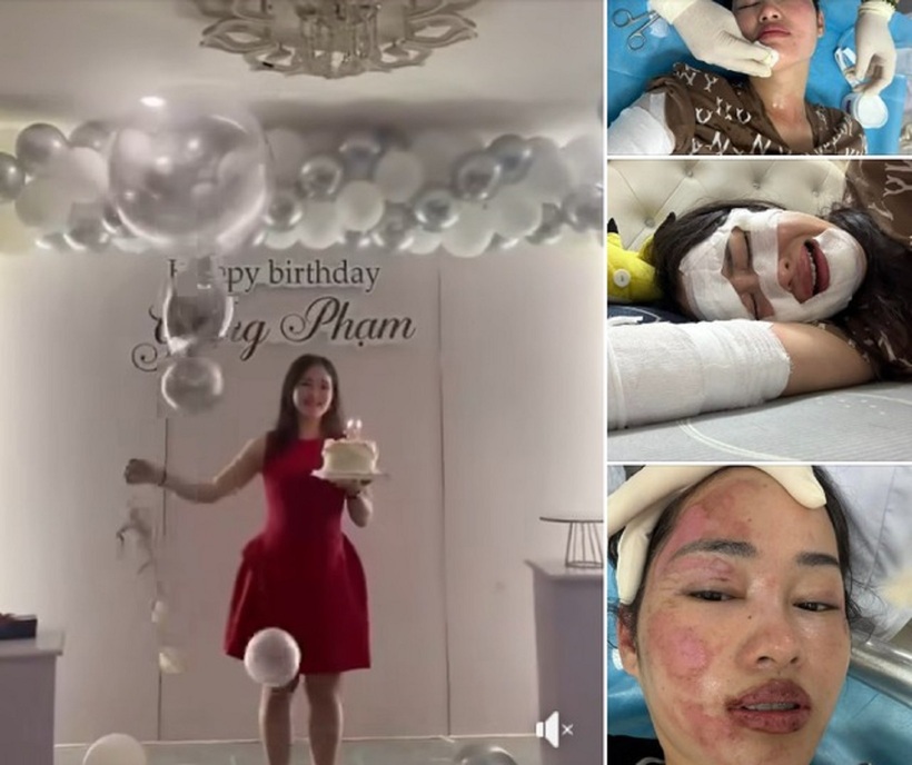 Cô gái xinh đẹp "bốc cháy", bỏng nặng ở tiệc sinh nhật. Ảnh: Sức khỏe & Đời sống