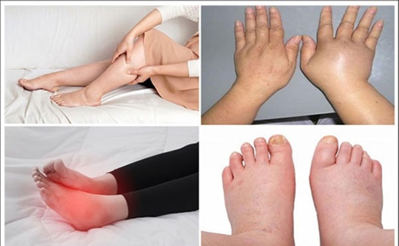 Thông thường phù được nhận thấy ở bàn tay, cánh tay, bàn chân, mắt cá chân và chân.