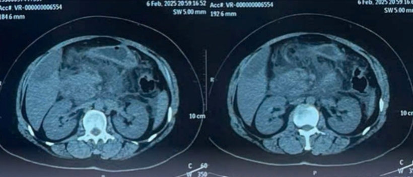 Hình ảnh CTscan tụy bệnh nhân trong tình trạng viêm nặng. Ảnh: Thời báo VTV