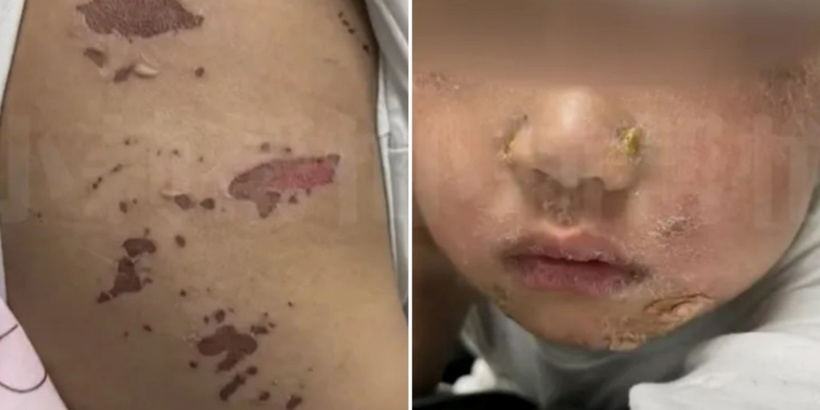Toàn thân bé trai bị lở loét. Ảnh: MSNews.