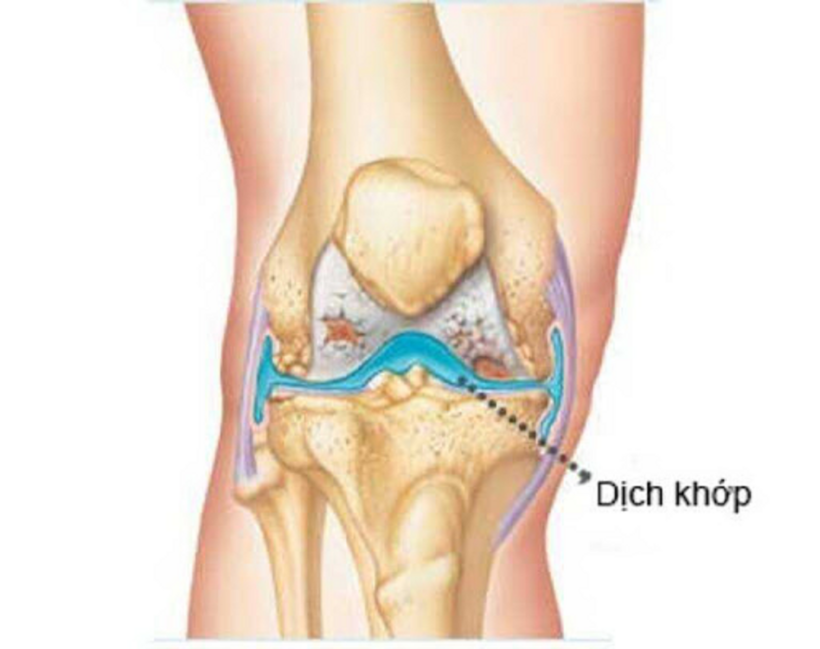Dịch khớp bị đông đặc khiến việc cử động khó khăn hơn