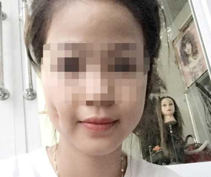 Má người phụ nữ biến dạng, mất cân đối vì một bên má lúm hõm sâu. Ảnh minh họa.