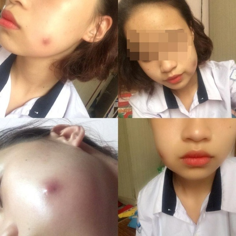 Khuôn mặt biến dạng của cô gái trẻ sau khi tạo má lúm. Ảnh: Tạp chí Tri Thức.