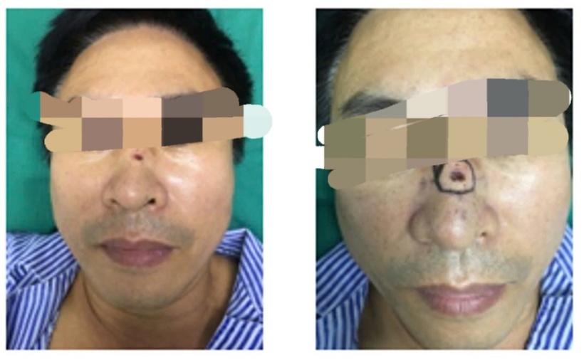 Từ vị trí nốt ruồi tưởng chừng "mang vận khí tốt" lại là dấu hiệu ung thư. Ảnh: BSCC