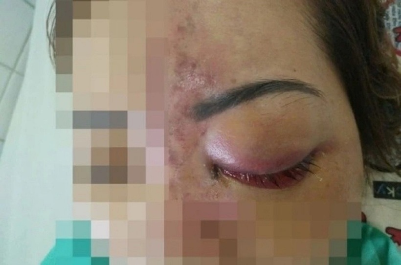 Người phụ nữ hoại tử da sau khi xăm lông mày "phong thủy" để đón lộc "cung điền trạch". Ảnh minh họa