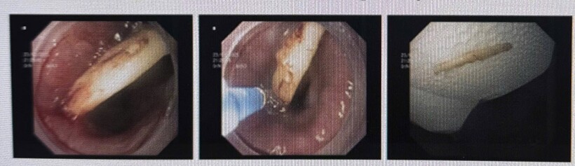 Xương gà trong thực quản bệnh nhân được các bác sĩ gắp bằng phương pháp nội soi. Ảnh: BVCC