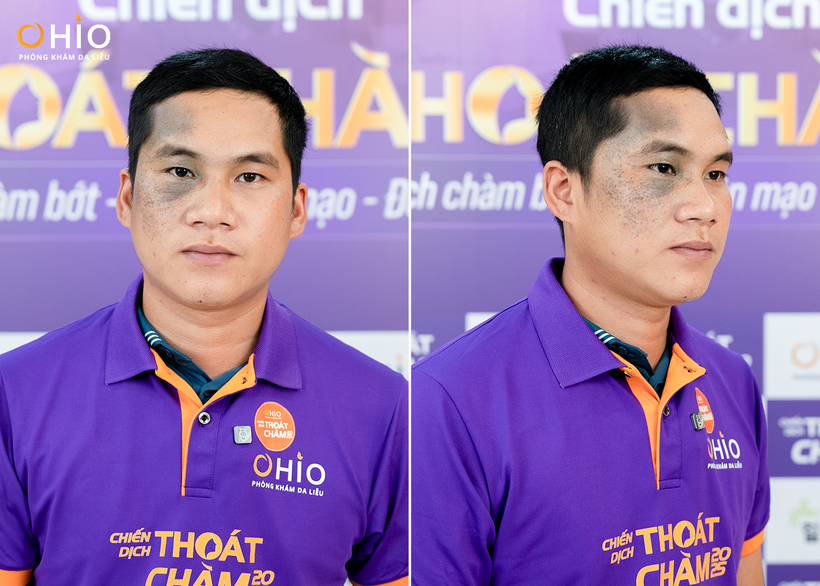 Tình trạng chàm đen của anh Lê Sỹ Luân
