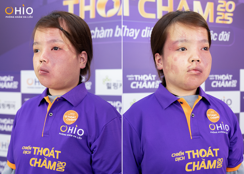 Tình trạng chàm đỏ u máu của bạn Chu Thị Ngọc Mai