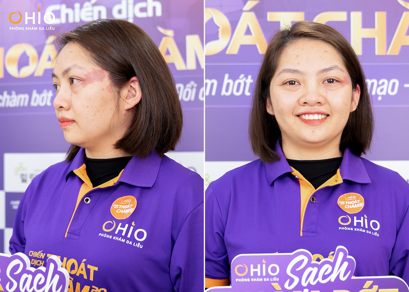 Tình trạng chàm đỏ của chị Nguyễn Thị Thu Hường