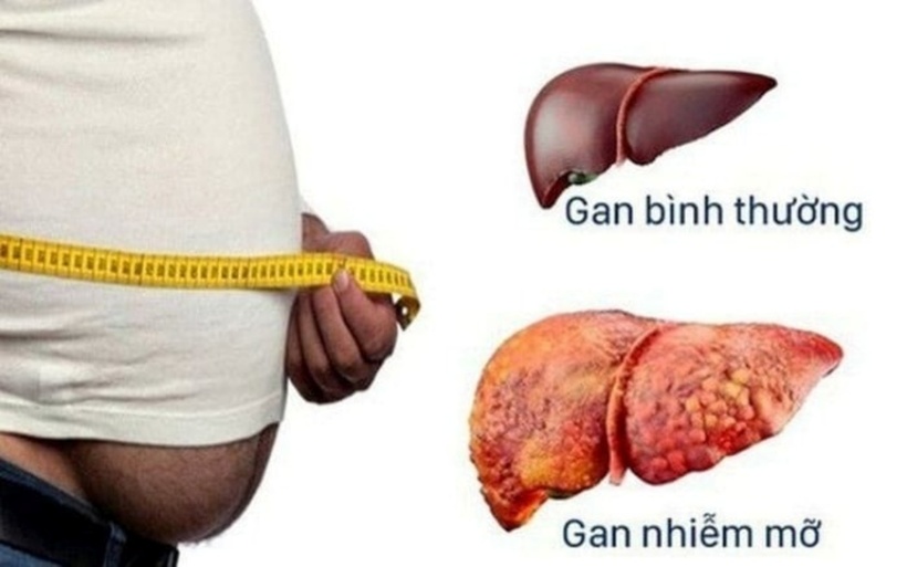 Gan nhiễm mỡ là tình trạng chất béo tích tụ quá mức cản trở hoạt động bình thường của gan và làm chậm quá trình sản xuất insulin hoặc mật. Ảnh minh họa.