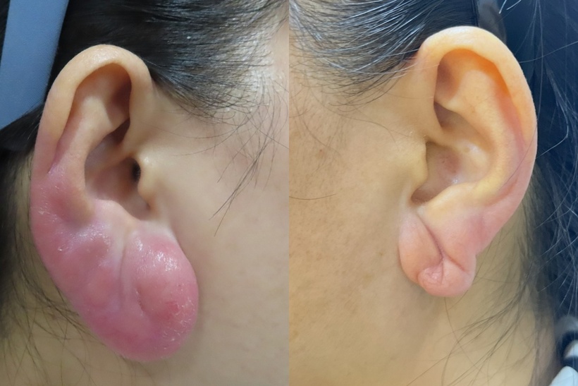 Tiêm "tai Phật" để đổi vận, người phụ nữ suýt "rước họa vào thân". Ảnh minh họa.