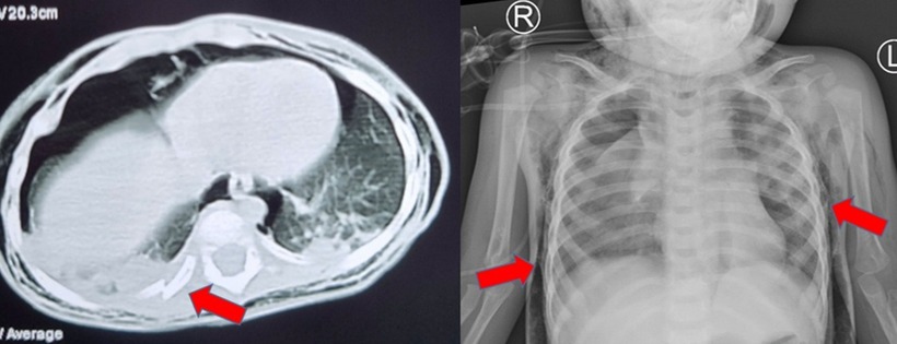 Kết quả chụp CT scan và X-quang phổi cho thấy trẻ bị tràn khí trung thất, tràn khí dưới da và gãy xương sườn. Ảnh minh hoạ.