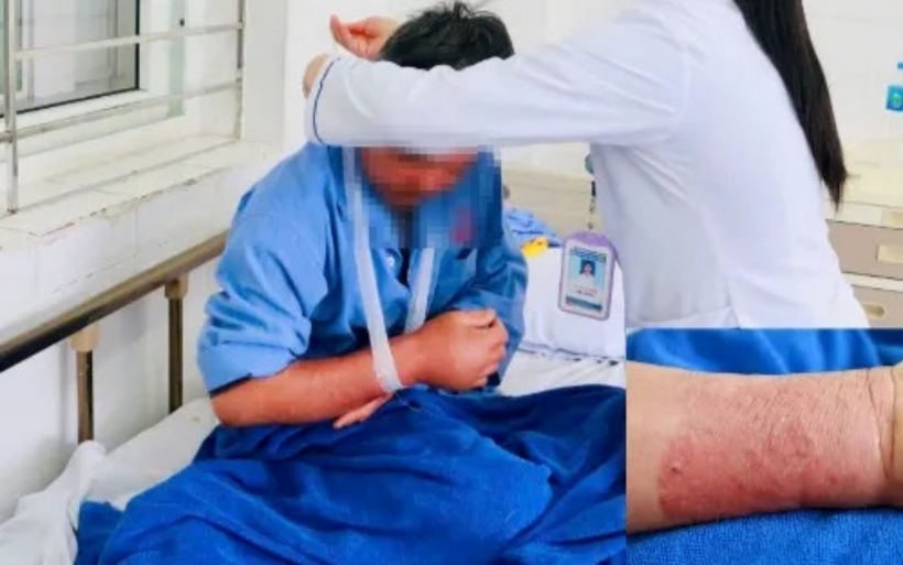 Tình trạng vùng cẳng tay phải của bệnh nhân sau khi đắp thuốc lá giảm đau. Ảnh: Thời báo VTV