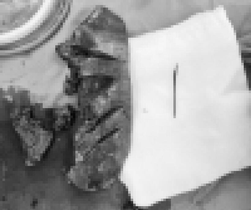 Nuốt phải tăm tre khiến cụ ông phải cắt bỏ thùy gan trái. Ảnh: BVCC