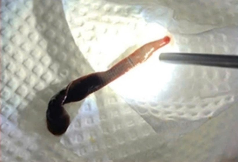 Con vắt dài 8cm sống nhiều ngày trong mũi người phụ nữ ở Đồng Nai. Ảnh: Báo Tiền phong.