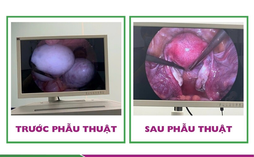 Hình ảnh 2 khối u bì lớn trong buồng trứng của người trước và sau phẫu thuật