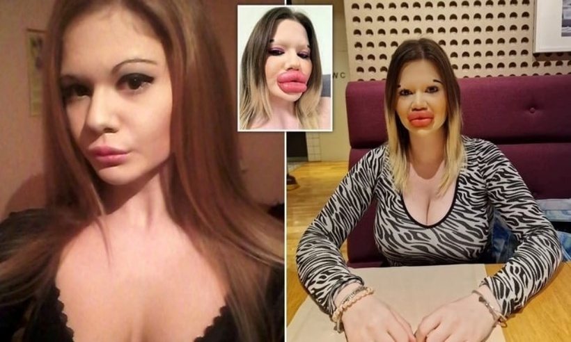Andrea trước và sau khi phẫu thuật thảm mỹ. Ảnh: Daily Mail.