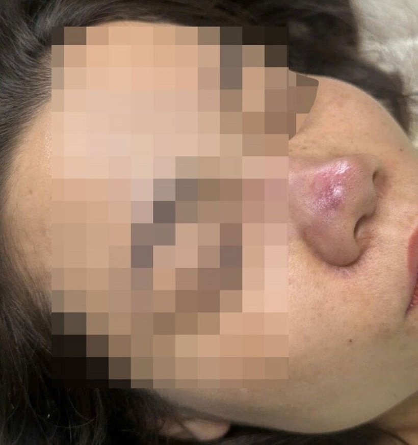 Trường hợp biến chứng sau tiêm filler mũi. Ảnh: Gia đình Việt Nam