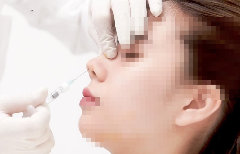 Tiên filler là một phương pháp ít xâm lấn, hiệu quả cao, nhưng cần được thực hiện bởi bác sĩ chuyên khoa. Ảnh minh họa