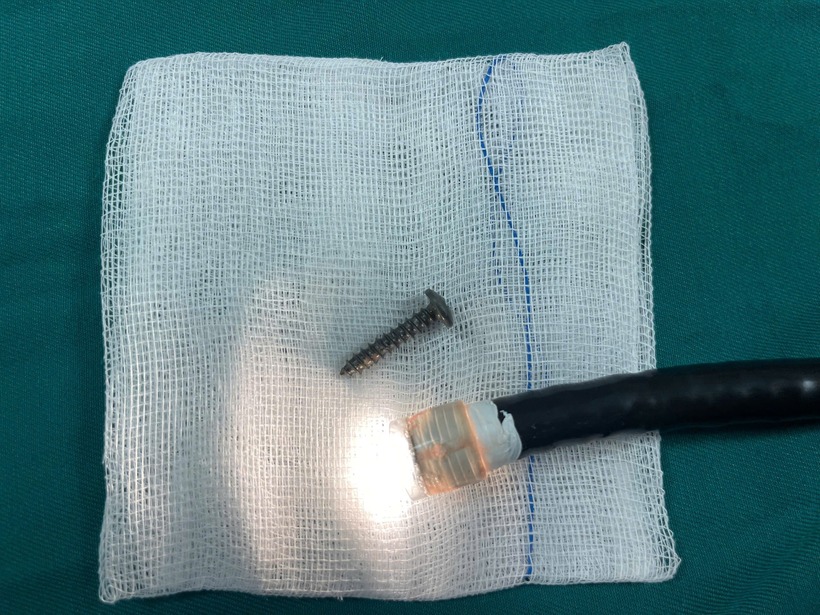 Dị vật được các bác sĩ gắp ra ngoài. Ảnh: Báo Quảng Trị