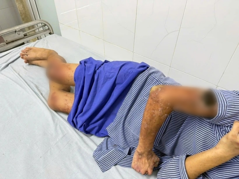 Khi các tổn thương da lan rộng, hình thành các mảng trợt loét, rỉ dịch, bệnh nhân mới đến bệnh viện thăm khám. Ảnh: VietnamPlus