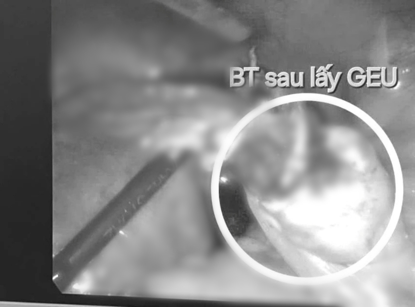 Hình ảnh mổ nội soi buồng trứng sau lấy thai ngoài tử cung. Ảnh: Pháp Luật TP.HCM