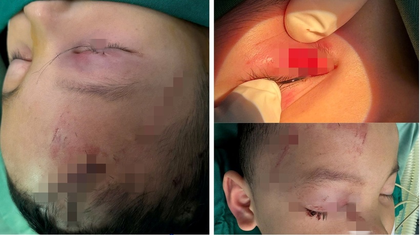 Bé trai 3 tuổi nhập viện khẩn cấp vì bị chó hàng xóm cắn trọng thương. Ảnh: BVCC.