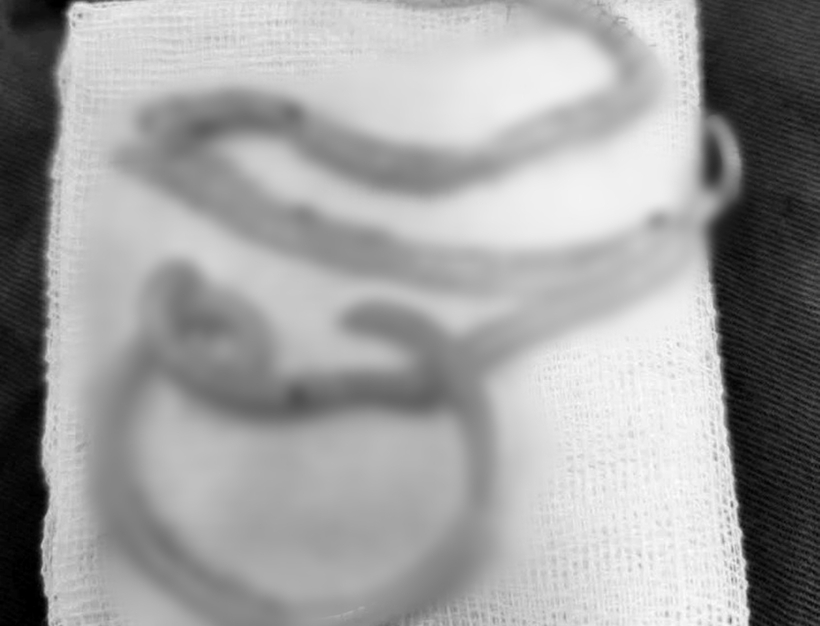 Ekip phẫu thuật phát hiện ruột non bệnh nhân bị giun đũa đục thủng, gây tràn dịch ổ bụng. Ảnh: Pháp Luật TP.HCM