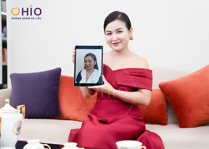 Chị Bích Ngọc 38 tuổi Khách hàng điều trị nám da thành công.