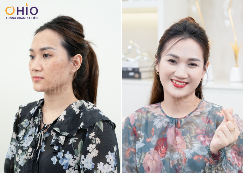 Chị Quỳnh, Hải Châu, Đà Nẵng điều trị nám thành công