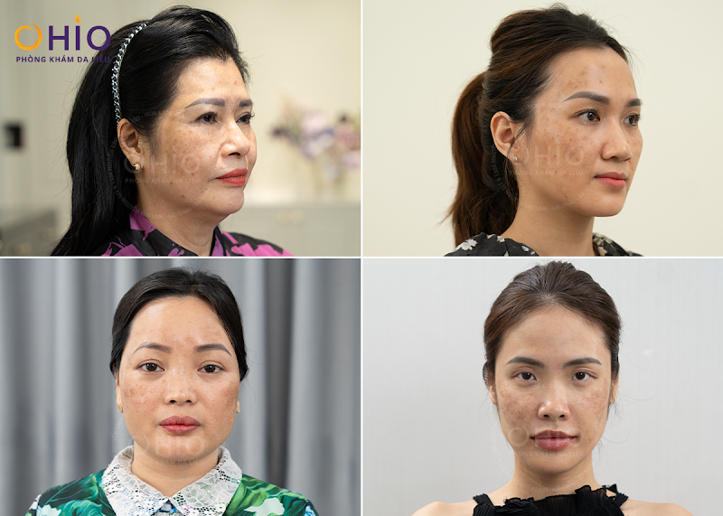 Tình trạng nám da gây ảnh hưởng tới thẩm mỹ