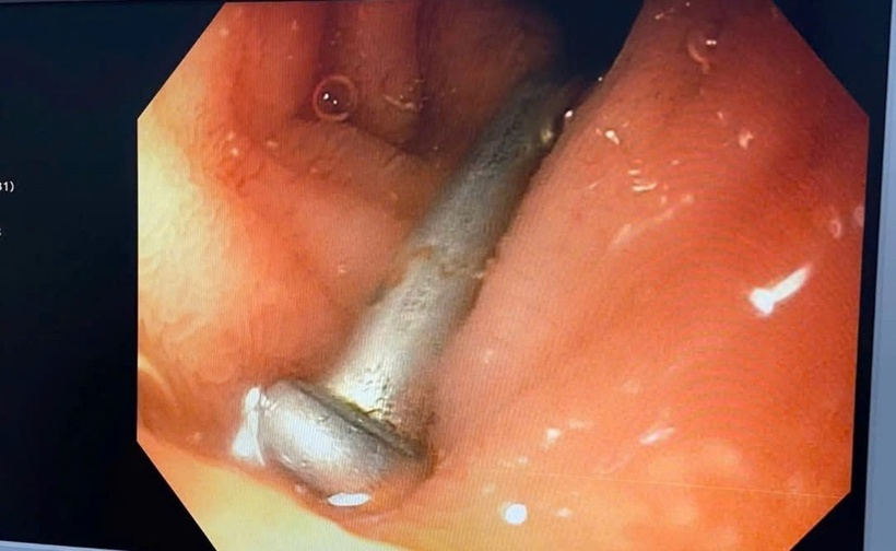 Dị vật là chiếc đinh 3 cm trong đường tiêu hóa bệnh nhi. Ảnh: VOV.