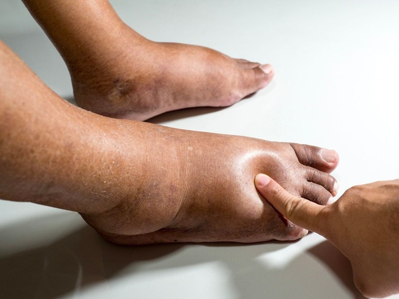 Những khu vực như: mắt cá chân, bàn chân, cẳng chân là nơi dễ dàng nhận thấy nhất vào buổi sáng sau khi thức dậy.