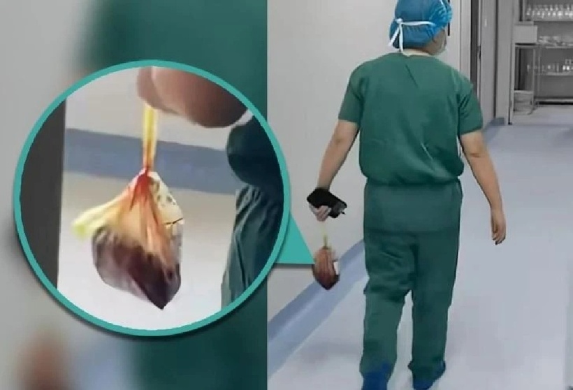 Bác sĩ Trung Quốc gây phẫn nộ khi đánh cắp nhau thai của sản phụ. Ảnh: SCMP.