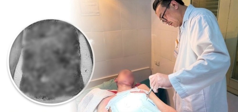 Bệnh nhi nhập viện trong tình trạng bị bỏng vùng ngực, bụng, đùi 2 bên nền đen, khô, sờ cứng, các vết nứt rỉ dịch, xung quanh sưng nề nhiều. Ảnh: Sức Khỏe & Đời Sống