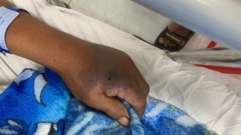 Vết rắn hổ đất cắn trên tay trái của ông H, gây bầm tím. Ảnh: Báo Giao thông