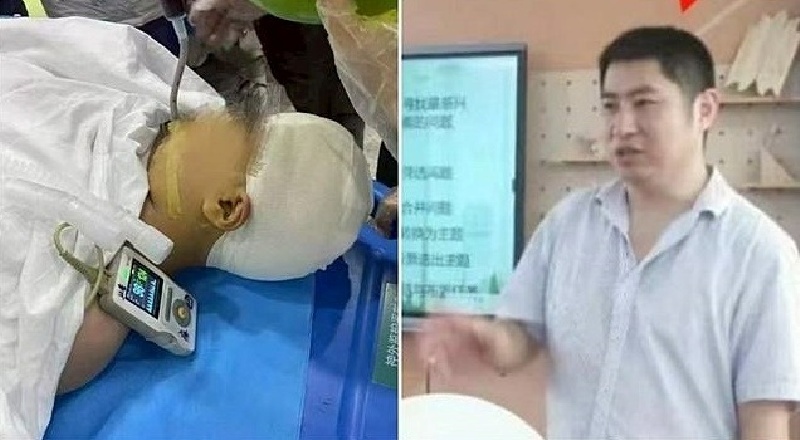 Lưu Thần sau ca phẫu thuật sọ não và Tống Vũ Minh. Ảnh: Sina.