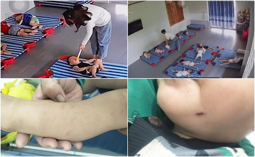 Phụ huynh cho biết, ngoài những vết bầm, thương tích nghi ngờ do bị đánh ở trường, trẻ thường xuyên giật mình, hoảng loạn, khóc đêm. (Ảnh: Lao động)