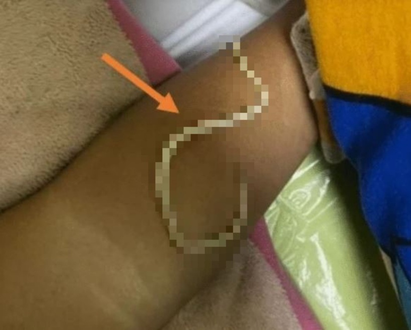 Vào ngày đầu tiên nhập viện, cậu bé bắt đầu nôn ra giun.
