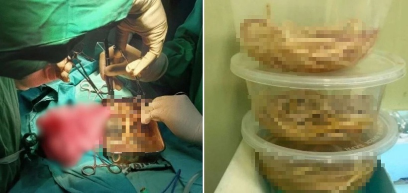 Ba bát ký sinh trùng được lấy ra từ ruột bệnh nhi.