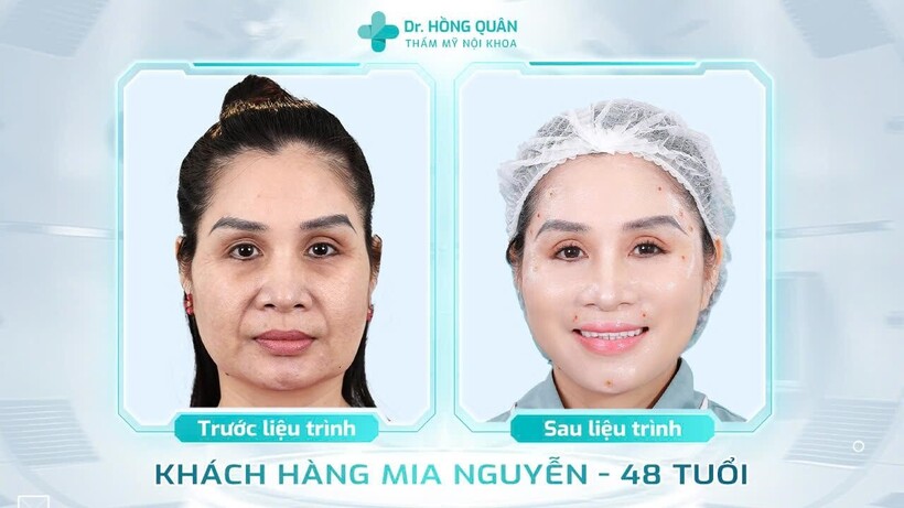 Hầu hết khách hàng được bác sĩ Quân thăm khám và điều trị đều cảm thấy hài lòng về kết quả thẩm mỹ,  sự tận tâm và chuyên nghiệp trong từng quy trình.