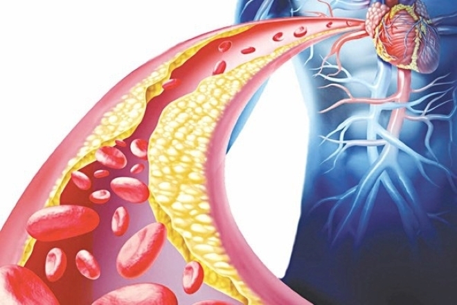 Mỡ máu cao được xem là "sát thủ thầm lặng" với sức khỏe