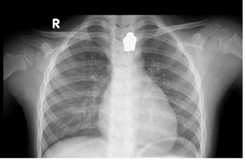 Kết quả chụp X-quang ghi nhận, dị vật hình ngôi sao cản quang mắc tại vùng cổ. Ảnh: Sức Khỏe & Đời Sống