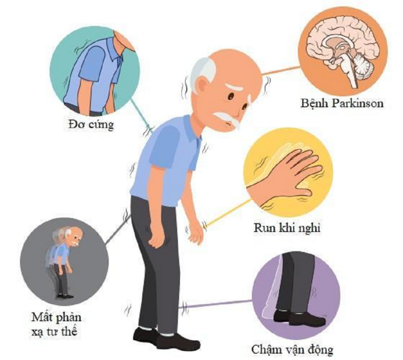 Triệu chứng Parkinson khá phức tạp, gây ảnh hưởng đến sinh hoạt hằng ngày